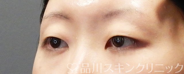 症例NO.73381のBEFORE写真