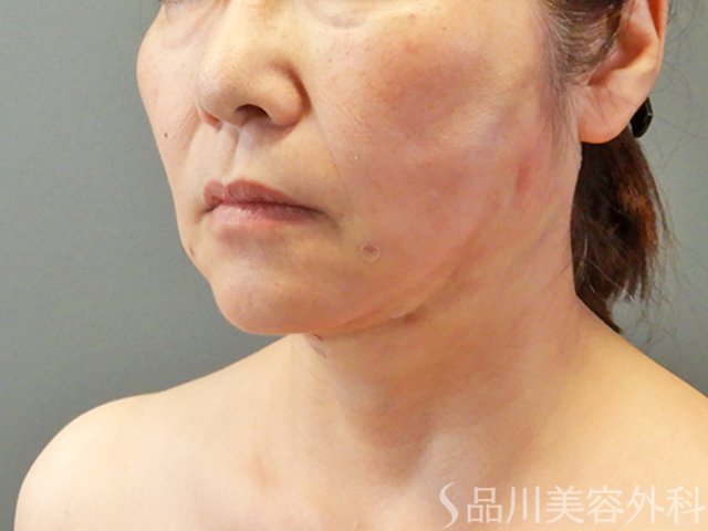 症例NO.67753のAFTER写真