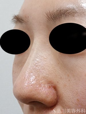 症例NO.75176のAFTER写真