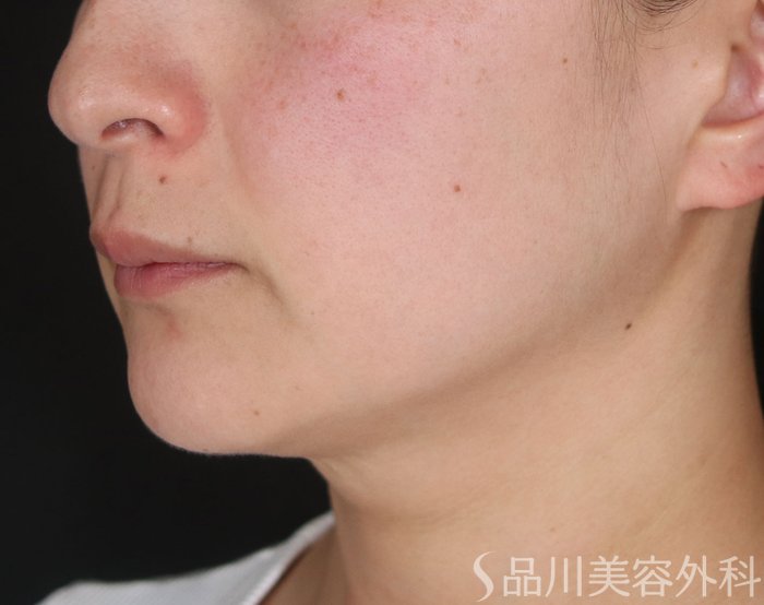 症例NO.73085のBEFORE写真