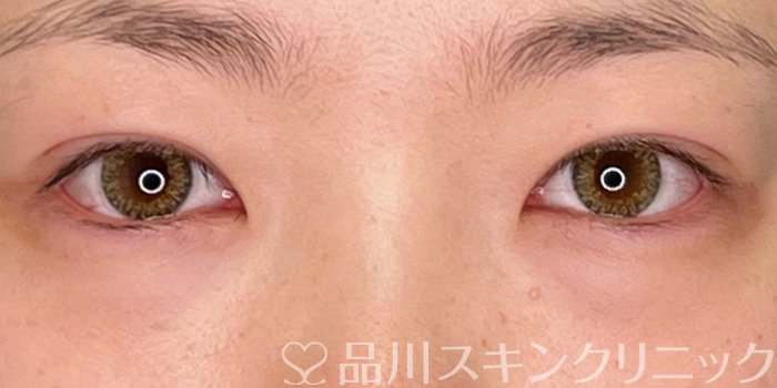 症例NO.69912のAFTER写真