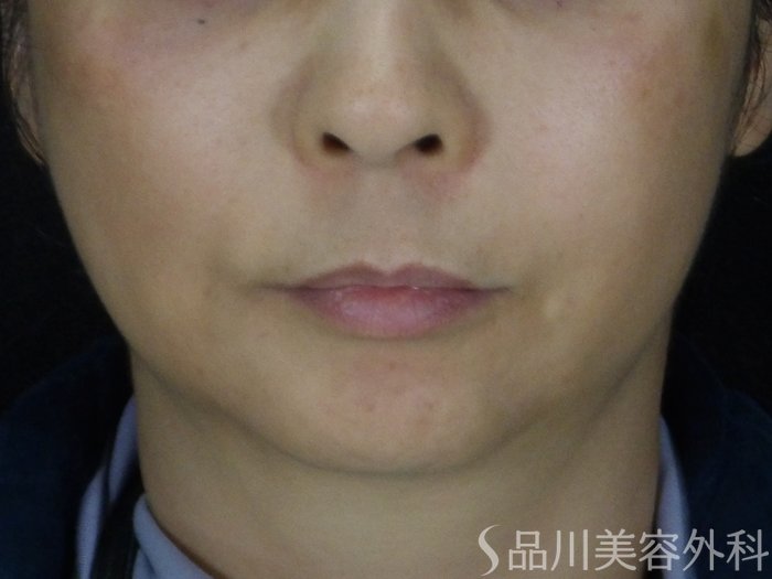 症例NO.68967のAFTER写真