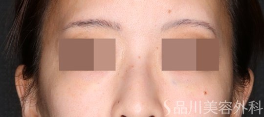 症例NO.74997のAFTER写真