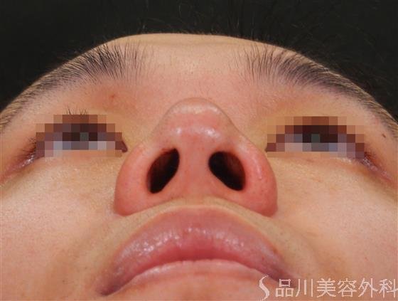 症例NO.61860のAFTER写真