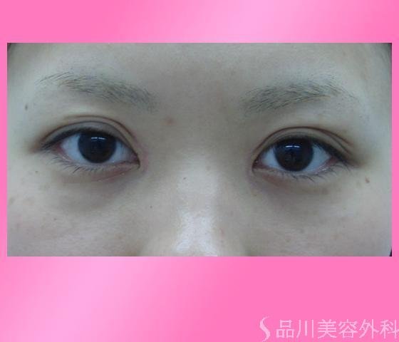 症例NO.2708のBEFORE写真