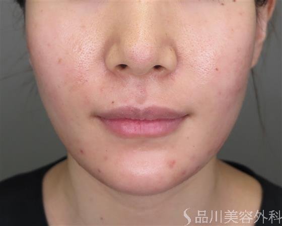 症例NO.47634のBEFORE写真