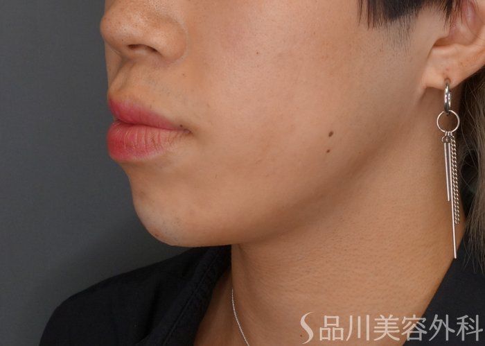 症例NO.75358のAFTER写真