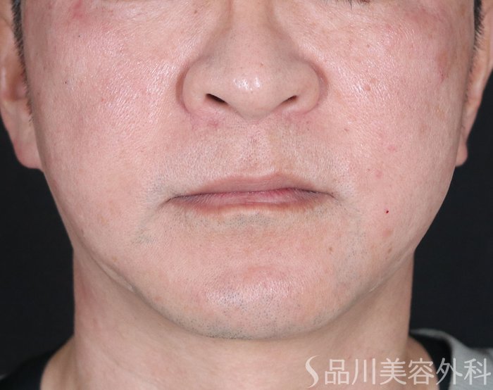 症例NO.72565のAFTER写真