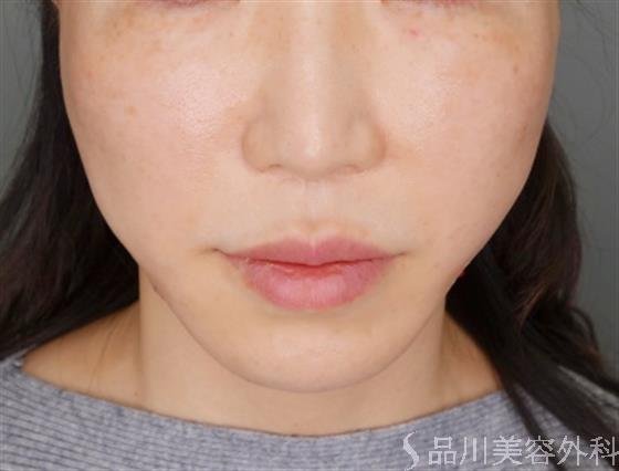 症例NO.54521のAFTER写真