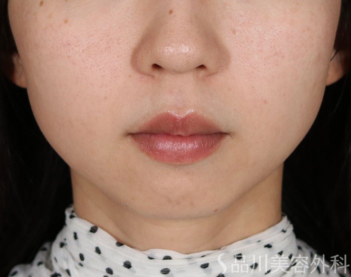 症例NO.71135のBEFORE写真