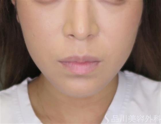 症例NO.48180のBEFORE写真