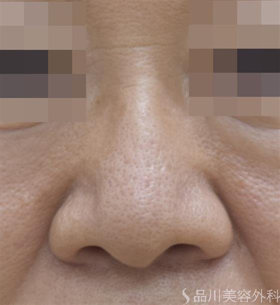 症例NO.45239のBEFORE写真