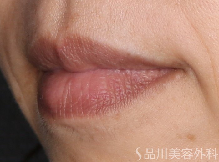 症例NO.70861のBEFORE写真