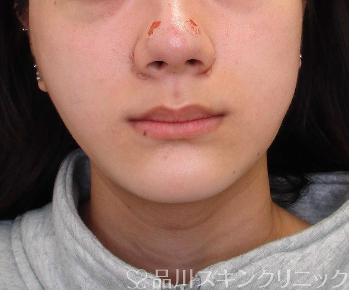 症例NO.65490のAFTER写真