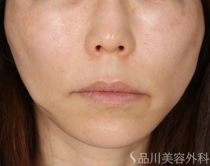 症例NO.74058のAFTER写真