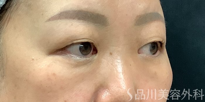 症例NO.71236のBEFORE写真