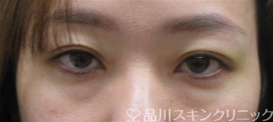 症例NO.60357のBEFORE写真