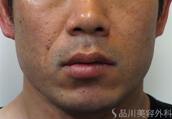 症例NO.47064のBEFORE写真