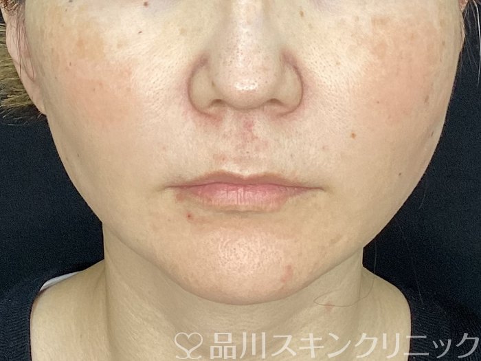 症例NO.72496のAFTER写真