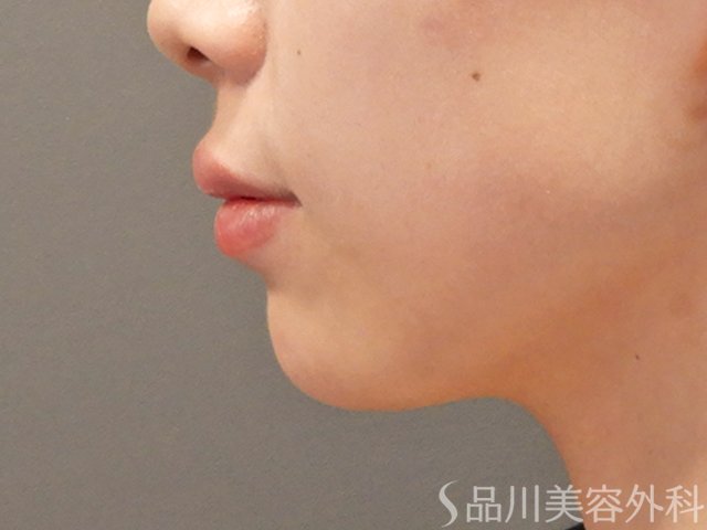 症例NO.72718のAFTER写真