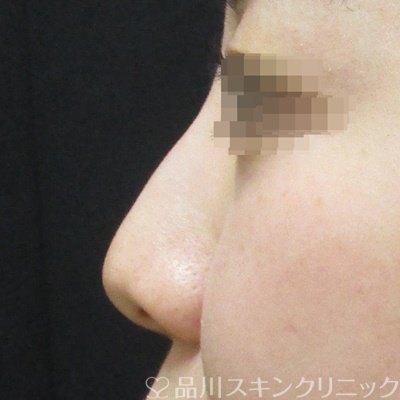 症例NO.70035のBEFORE写真