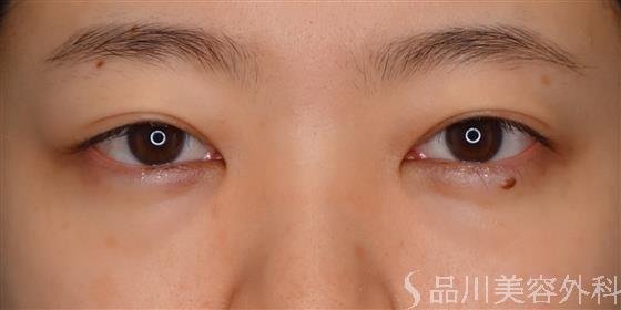 症例NO.55414のBEFORE写真