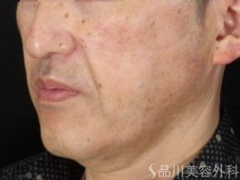 症例NO.70903のBEFORE写真