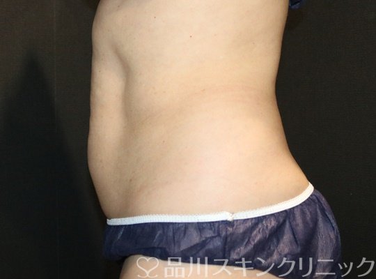 症例NO.74532のAFTER写真