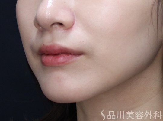 症例NO.73825のAFTER写真