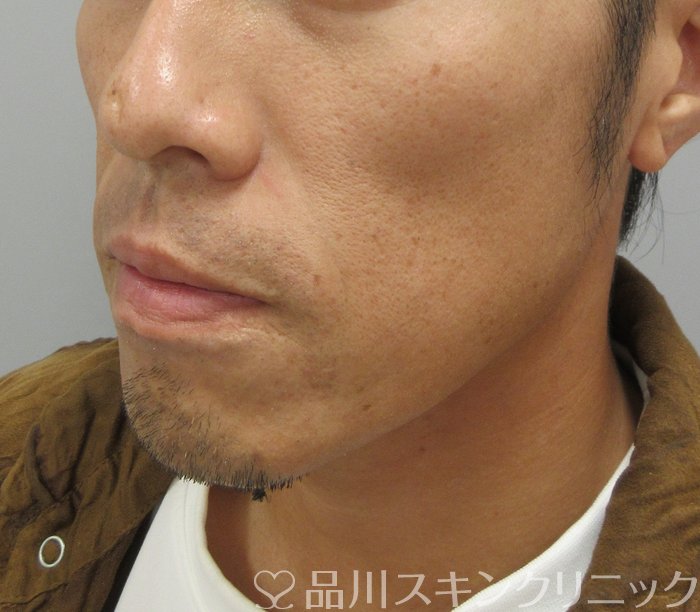 症例NO.74732のBEFORE写真