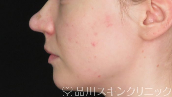 症例NO.71268のAFTER写真