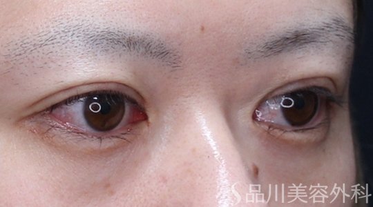 症例NO.74876のAFTER写真