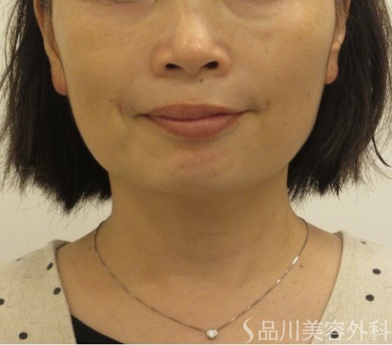 症例NO.71567のAFTER写真