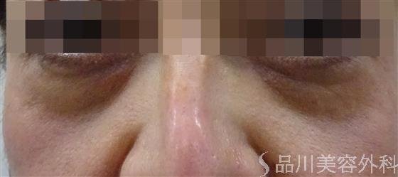 症例NO.40223のBEFORE写真