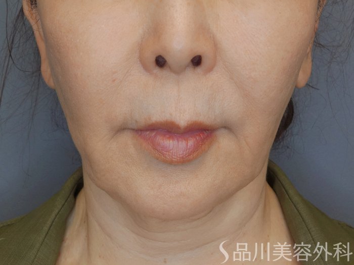 症例NO.70350のBEFORE写真