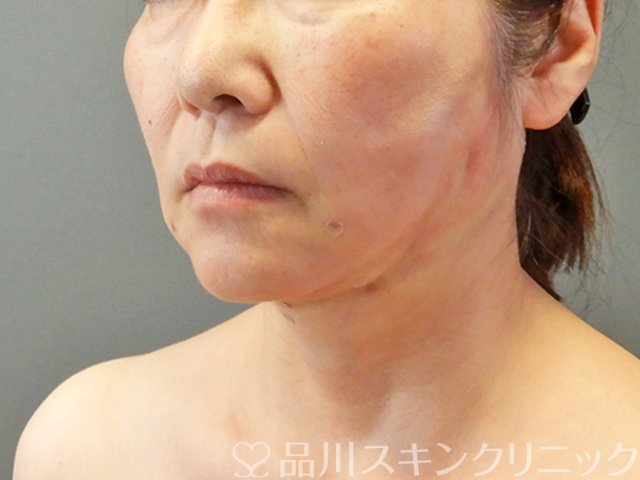 症例NO.67753のAFTER写真