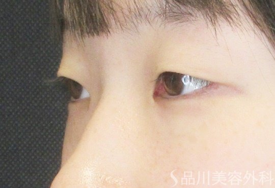 症例NO.69552のBEFORE写真