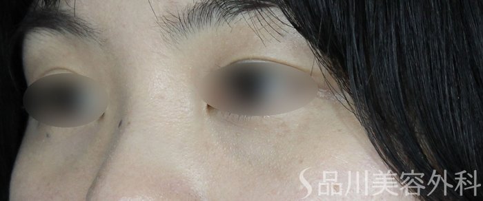 症例NO.65222のAFTER写真