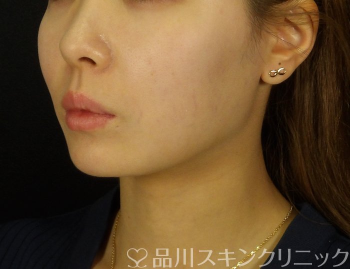 症例NO.72637のBEFORE写真