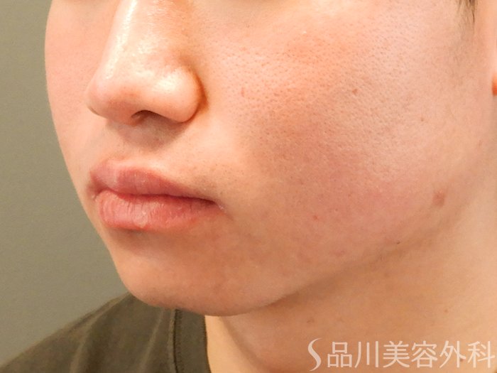症例NO.70245のAFTER写真