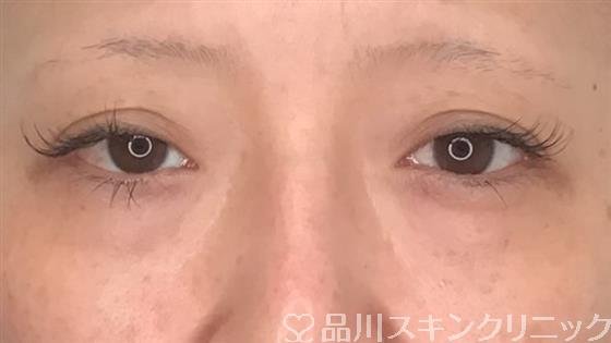 症例NO.60279のBEFORE写真