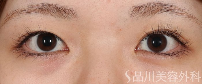 症例NO.71530のBEFORE写真
