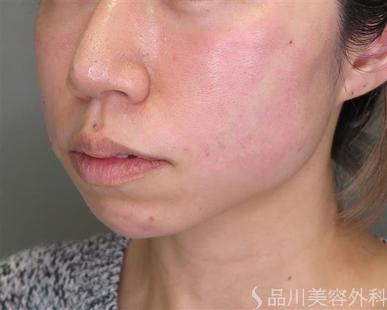 症例NO.49070のAFTER写真