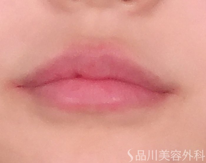 症例NO.70085のAFTER写真