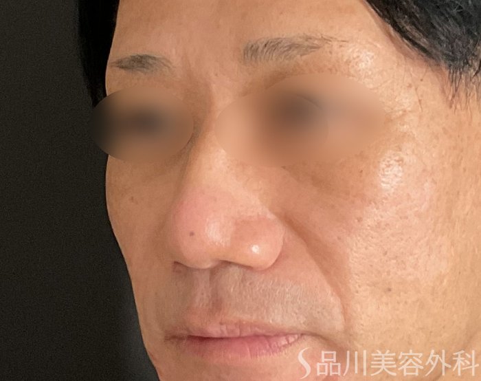 症例NO.74718のBEFORE写真