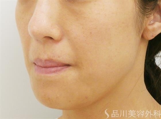 症例NO.30986のBEFORE写真