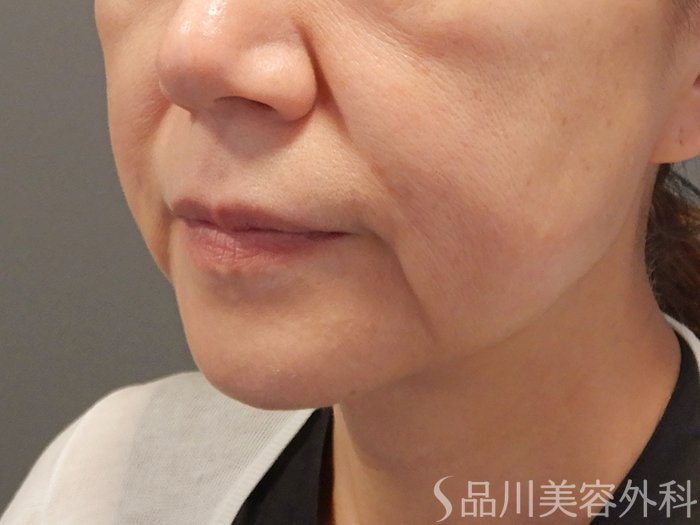症例NO.71112のBEFORE写真