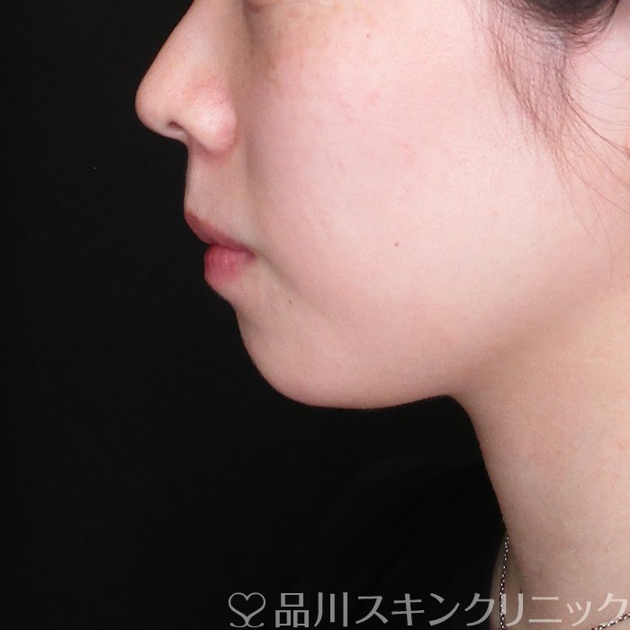 症例NO.74438のBEFORE写真