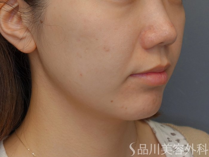 症例NO.74170のBEFORE写真