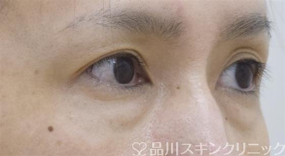 症例NO.52545のBEFORE写真